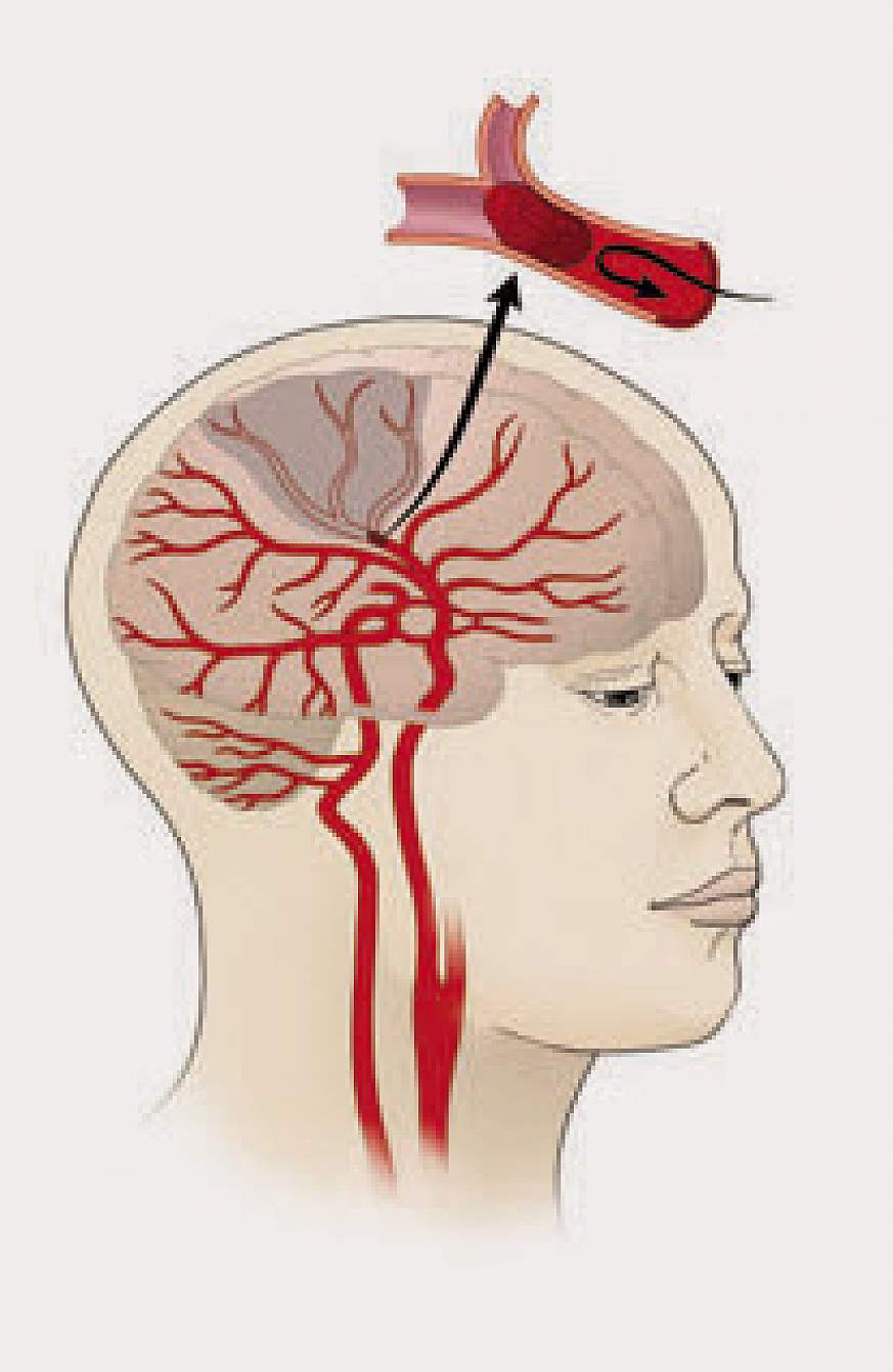 Illustration of an ischemic stroke