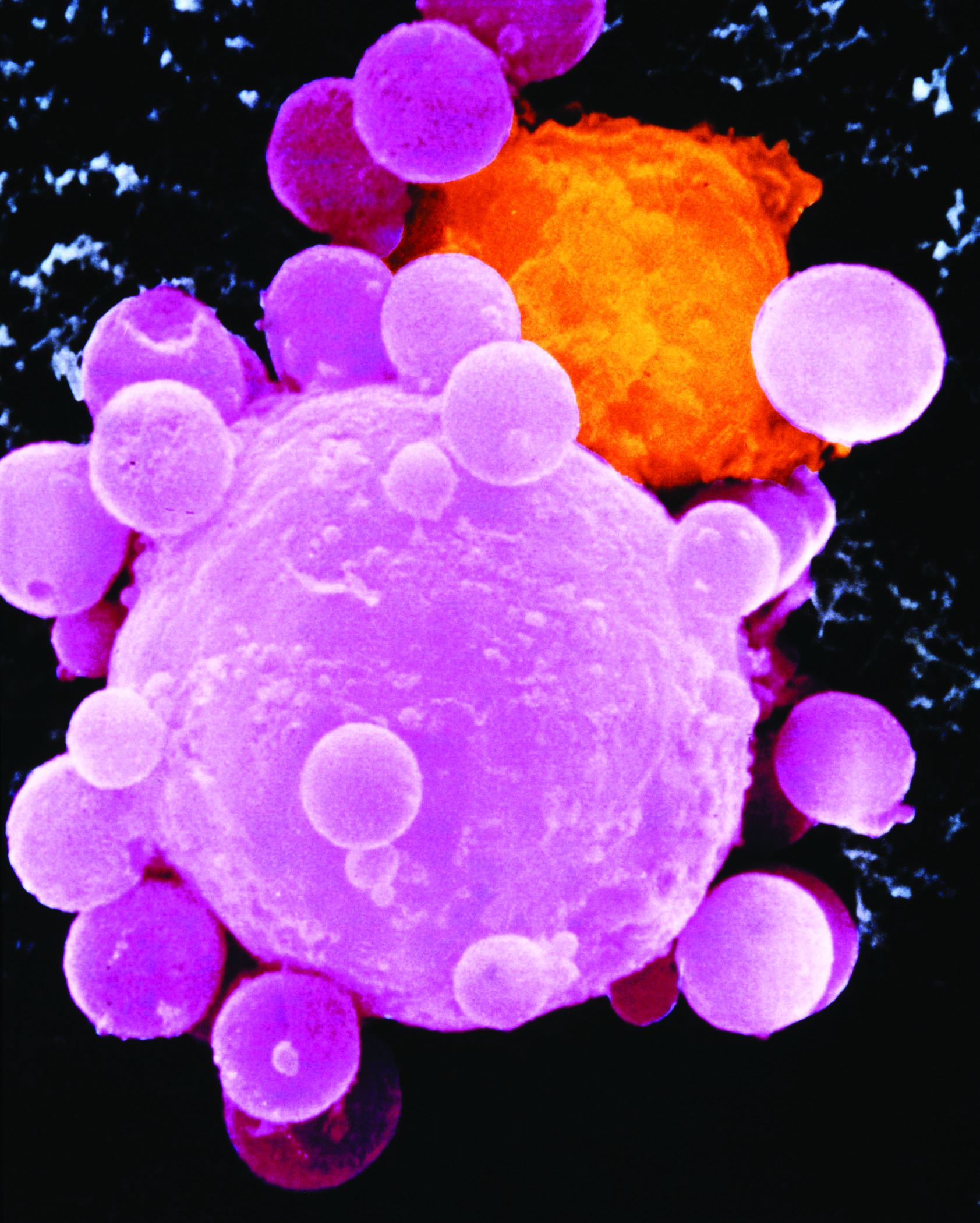 Lung cancer cell division. Colored scanning electron micrograph of a lung cancer cell during cell division.