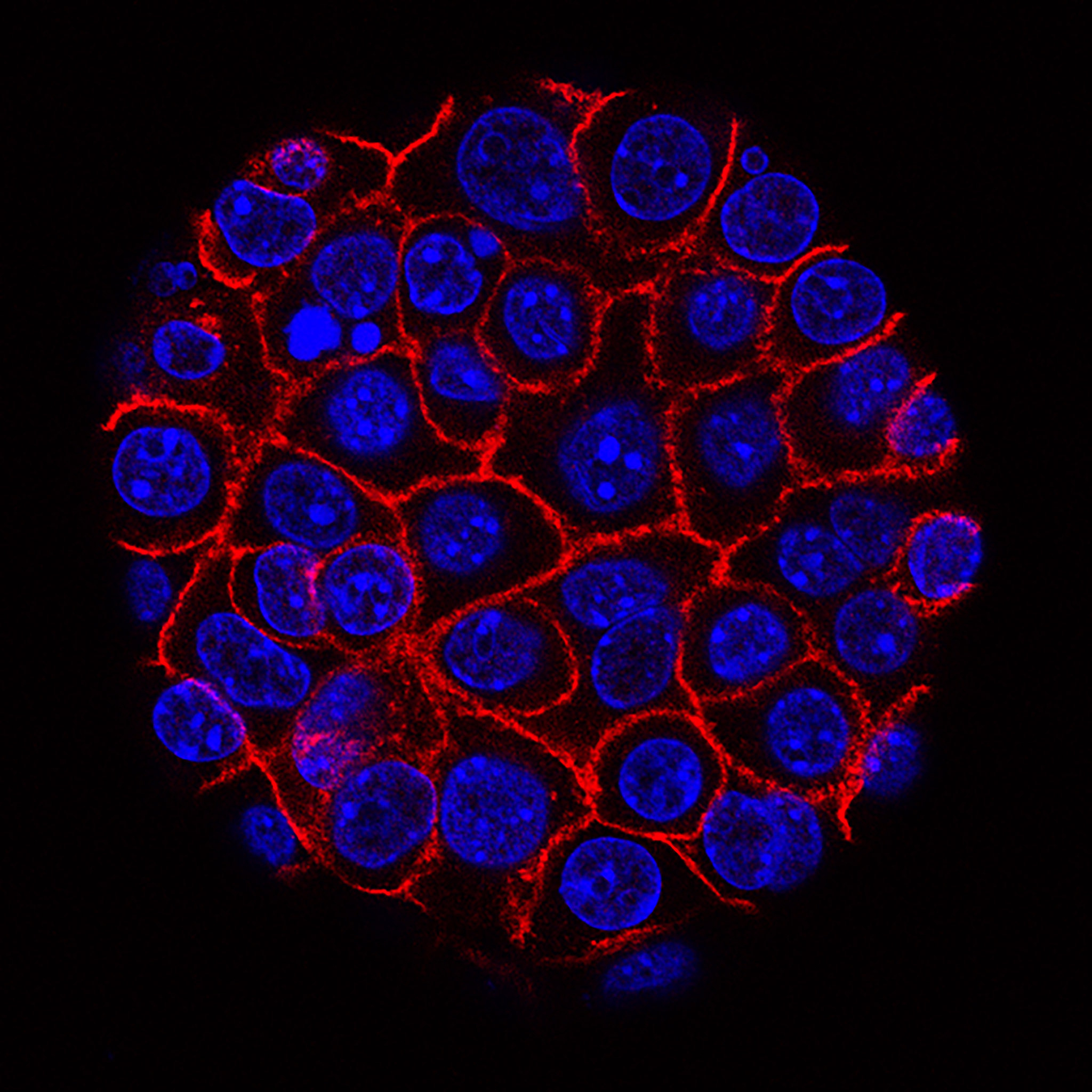 Pancreatic Cancer Cells Pancreatic Cancer Cells