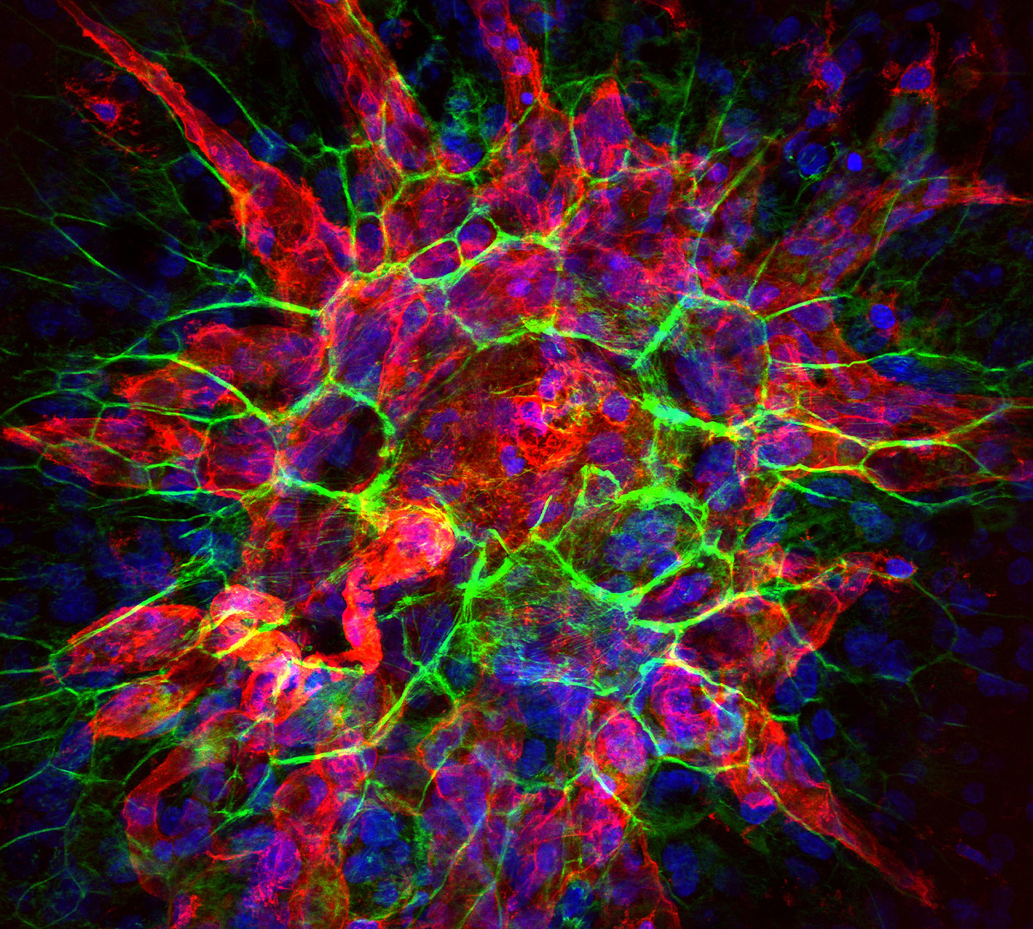 Choroidal neovascularization