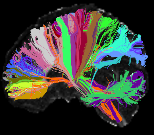 This High Angular Resolution Diffusion Image (HARDI) of the human brain shows long distance connections, or tracts. Wiring associated with particular brain structures share the same color.