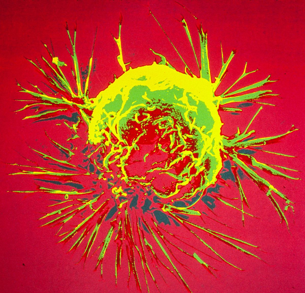 A breast cancer cell, photographed by a scanning electron microscope showing overall shape of the cell's surface at a very high magnification.