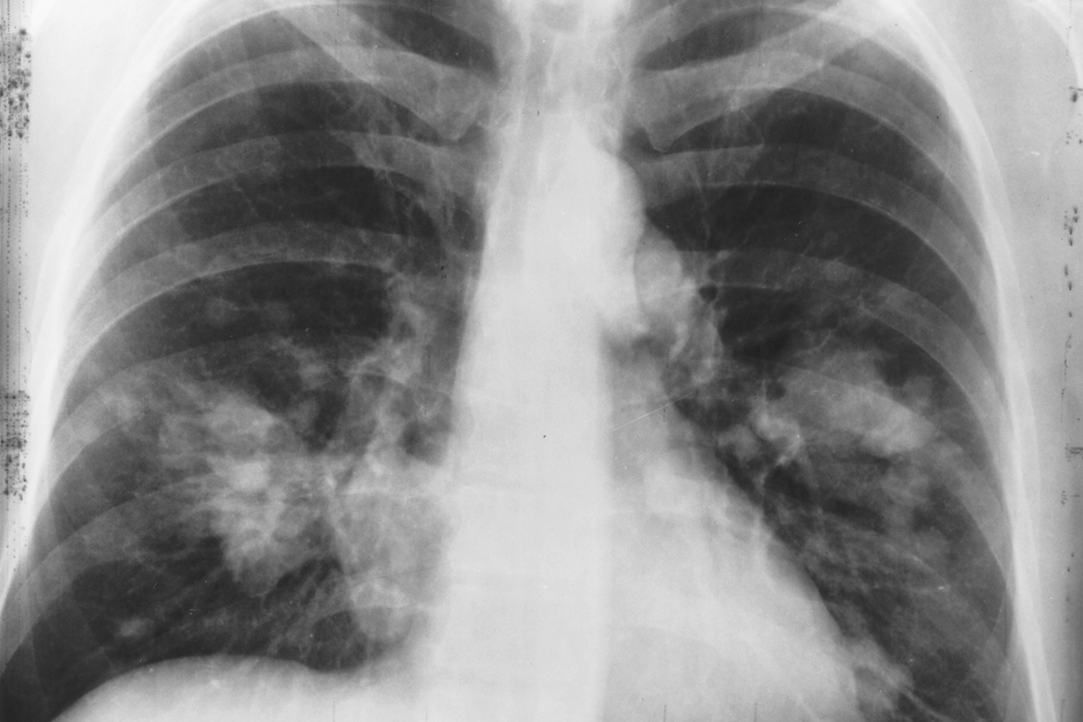 X-ray image of a chest. Both sides of the lungs are visible with a growth on the left side of the lung, which could possibly be lung cancer.