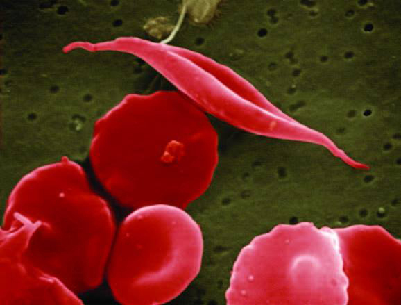 Magnified red blood cells and sickled cells.