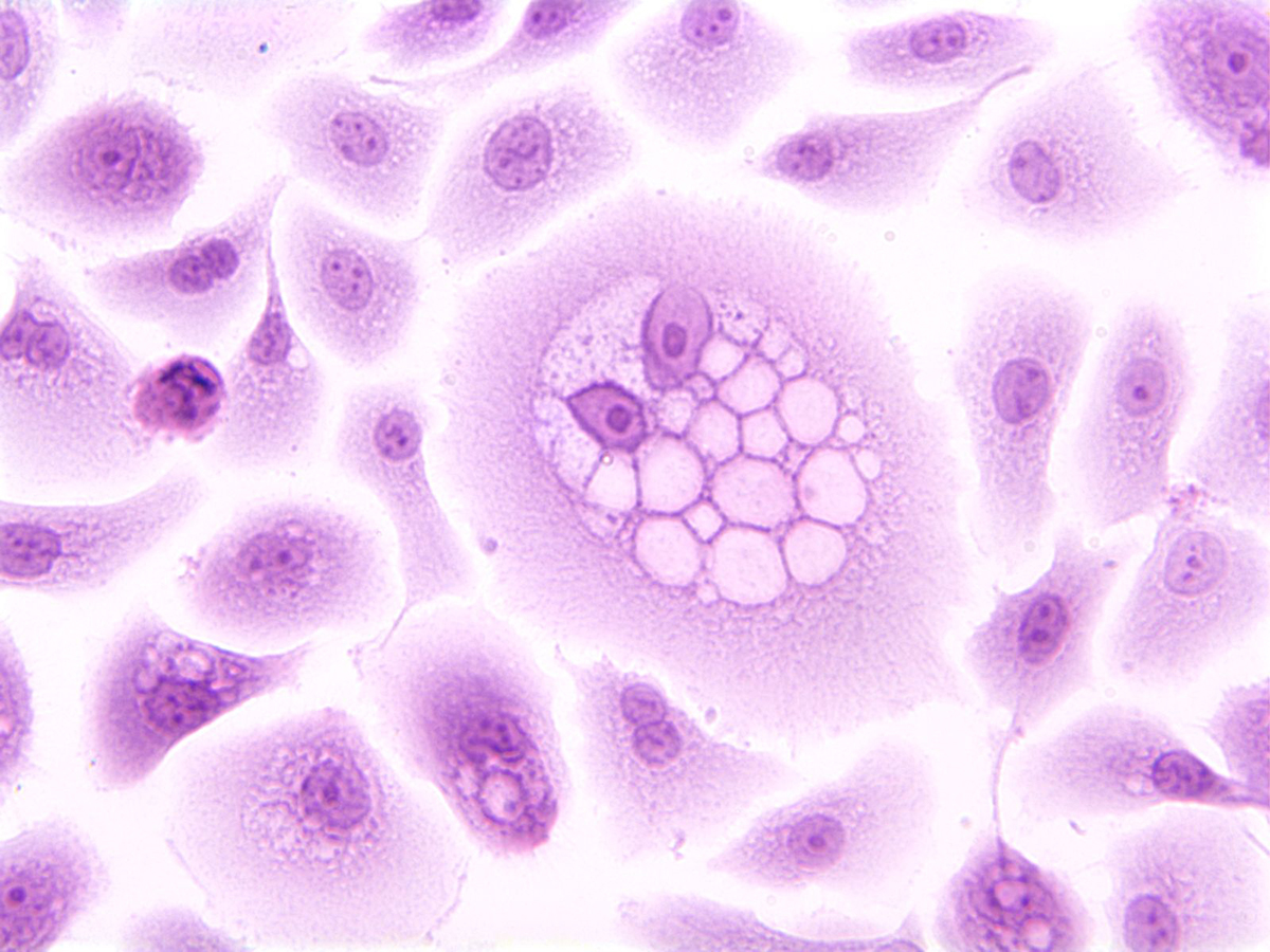 Purple cellular image stain of a koilocyte, a squamous epithelial cell that has undergone structural changes as a result of infection by human papillomavirus (HPV).