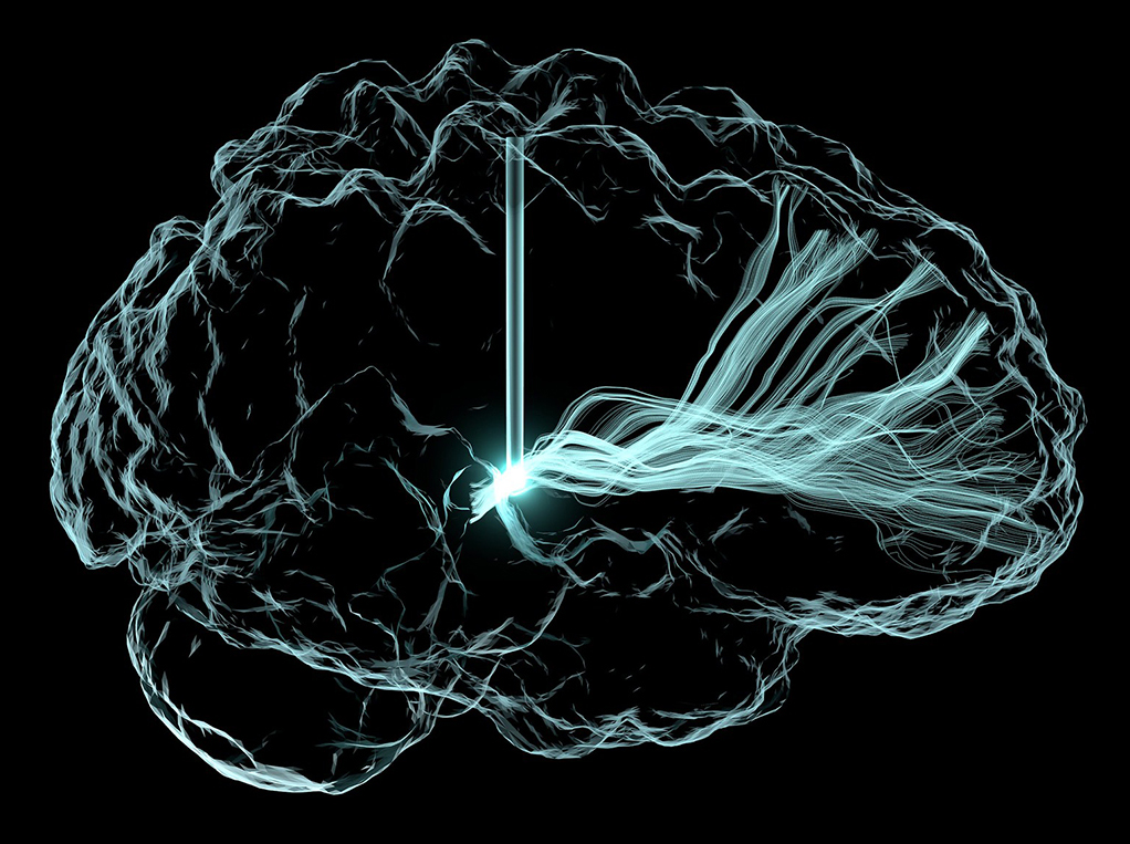 Artistic rendering of deep brain stimulation (DBS), with an outline of brain and vertical lines that represent wire leads with a single electrode that has been inserted deep within the brain to reach a region involved in cognition, the central thalamus.