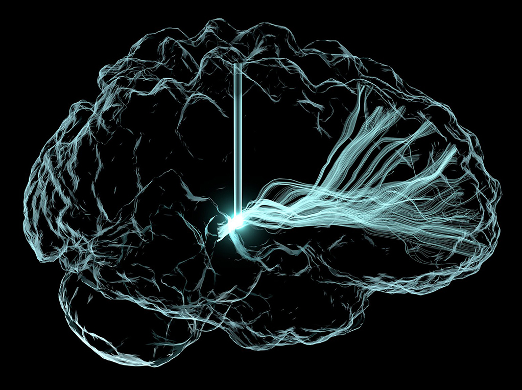 Brain and Mental Health Artistic rendering of deep brain stimulation (DBS), with an outline of brain and vertical lines that represent wire leads with a single electrode that has been inserted deep within the brain to reach a region involved in cognition, the central thalamus.