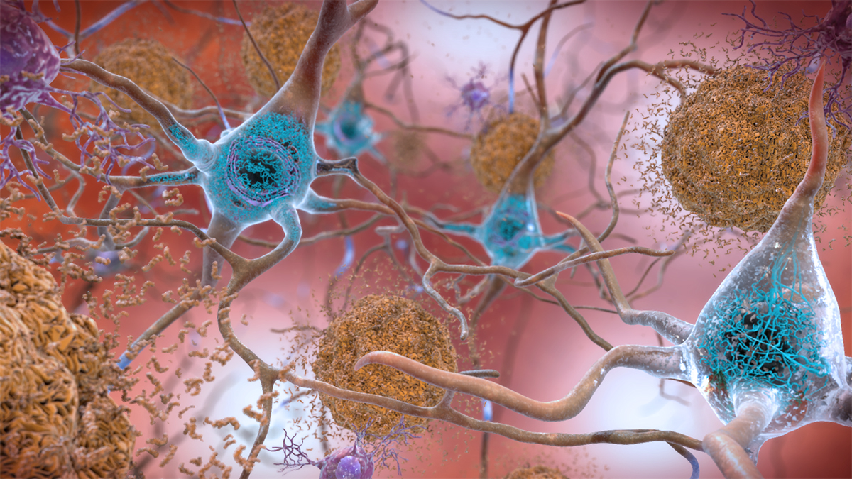 Alzheimer’s Disease Neuroimaging Illustration of amyloid plaques and tau tangles, colored in brown, surrounded by brain cells, colored in cyan and purple.