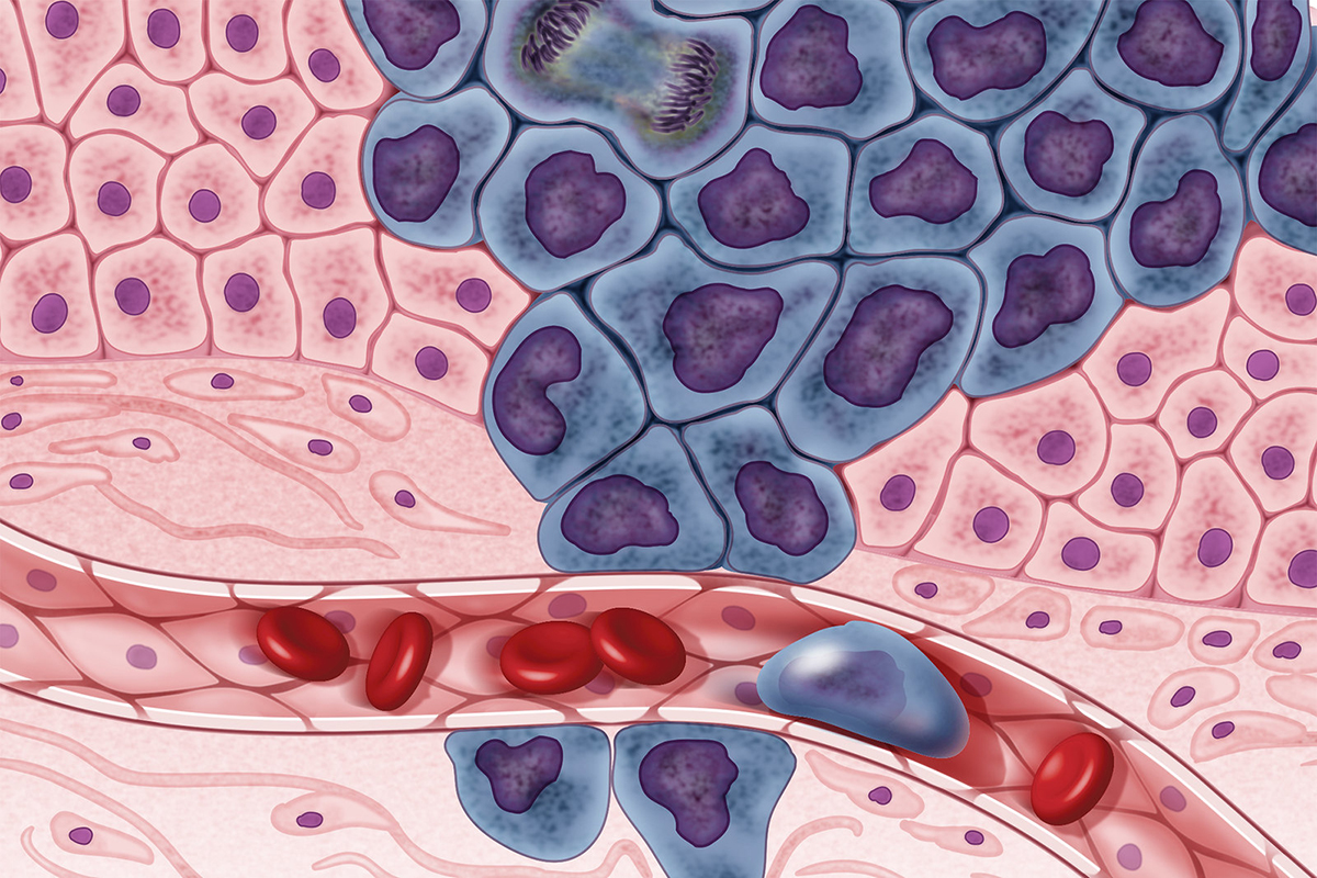 Growing cancer cells (in purple) are surrounded by healthy cells (in pink), illustrating a primary tumor spreading to other parts of the body through the circulatory system.