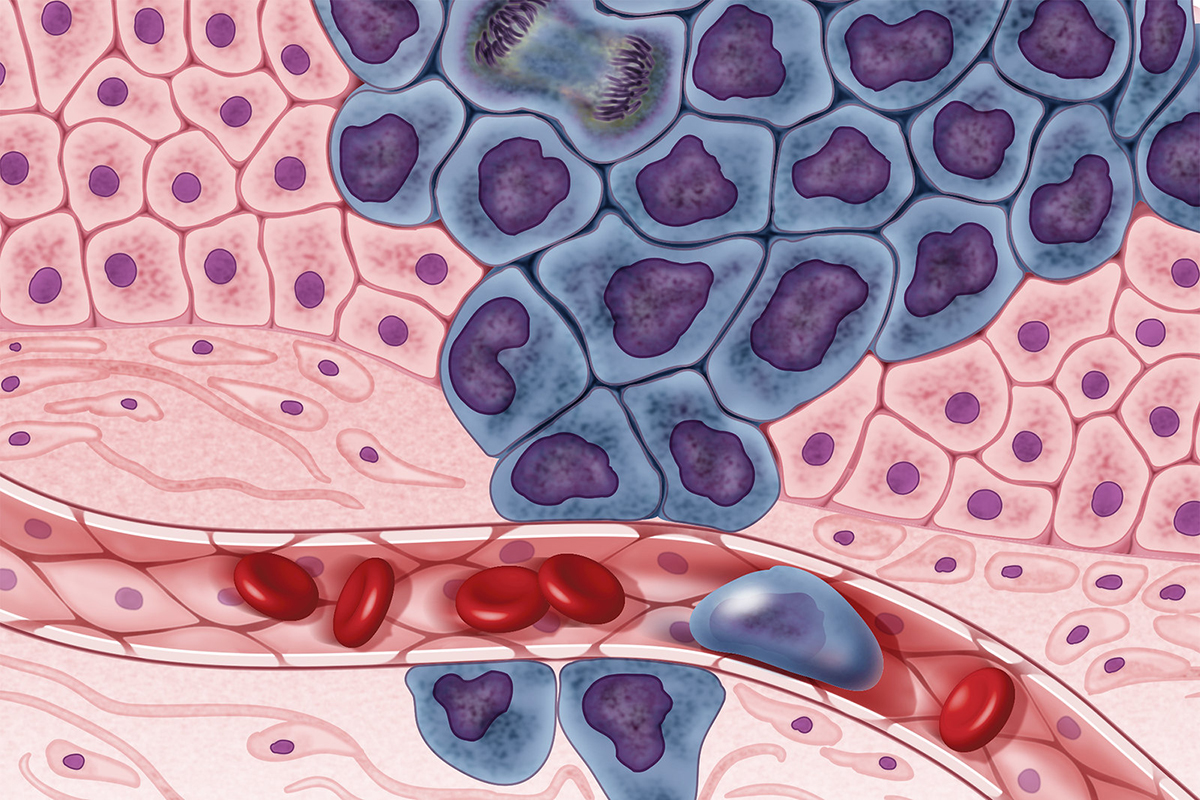 Cancer Genome Atlas Growing cancer cells (in purple) are surrounded by healthy cells (in pink), illustrating a primary tumor spreading to other parts of the body through the circulatory system.
