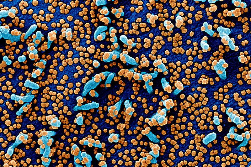 Housing and COVID-19 Colorized scanning electron micrograph of a blue colored cells heavily infected with SARS-COV-2 virus particles shown in orange.