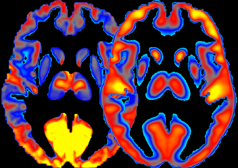 Brain images showing brain activity and glucose consumption
