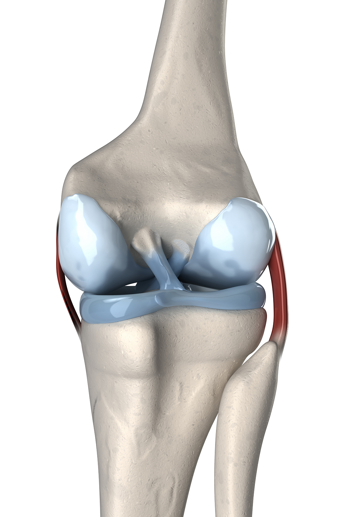 Knee joint illustration. The thigh bone (top bone) is connected to the shin bone (larger of the two bottom bones) by ligaments. One of these, the anterior cruciate ligament (diagonal strip between the rounded ends of the thigh bone) is particularly vulner