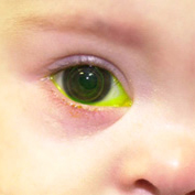 A child wearing a contact lens. A green dye is used to evaluate the fit of hard lenses.
