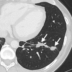 Black and white scan of lung with arrows pointing to metastatic tumors that have shrunk.