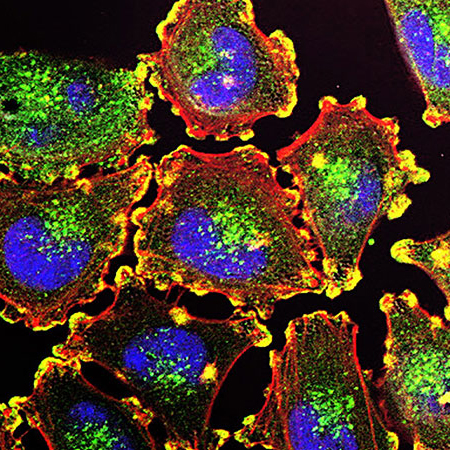 Metastatic melanoma cells.