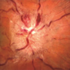 The optic nerve swelling.