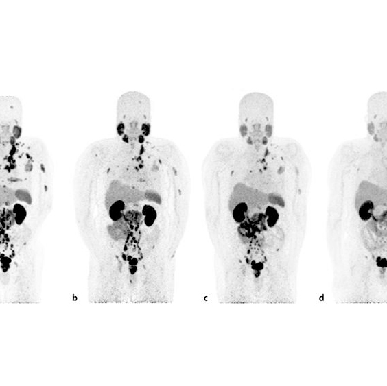 Series of PET/CT scans showing fewer tumors after 177lu-PSMA-617 treatment