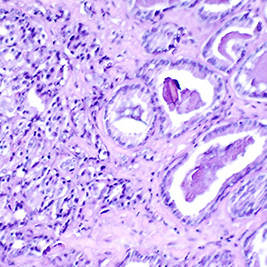 Histological slide of prostate cancer