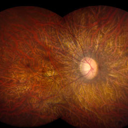 The retina, the light-sensitive tissue at the back of the eye.