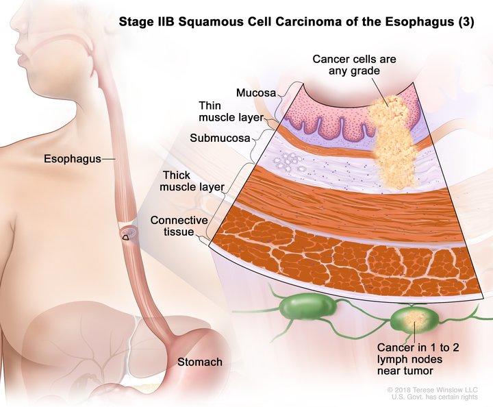 Anatomic illustration of stage 2b esophageal cancer Anatomic illustration of stage 2b esophageal cancer, with pop out of cancer cells in nearby lymph nodes.