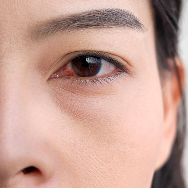 A closeup of a woman’s red eye