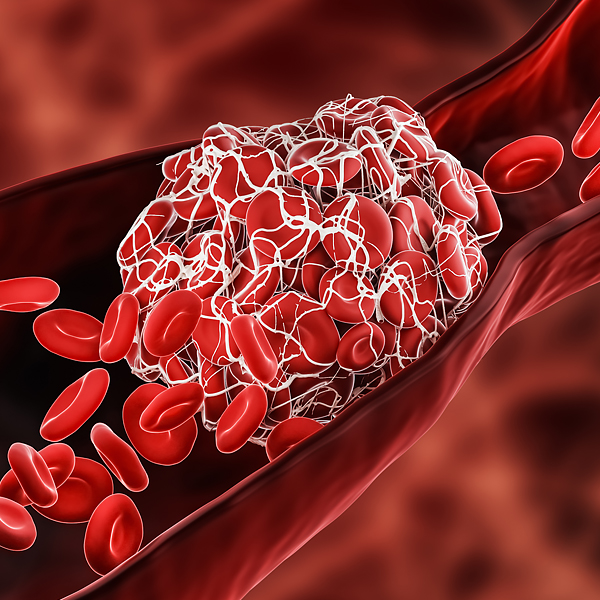 An illustration of a blood clot in a blood vessel