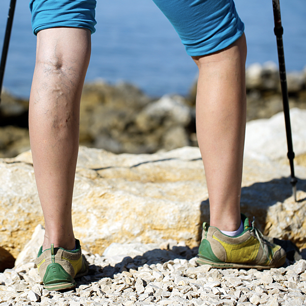 A woman's legs with varicose veins