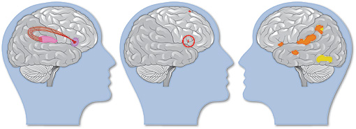 Brains compensating for dyslexia vs. brain of a typical reader Brains compensating for dyslexia vs. brain of a typical reader