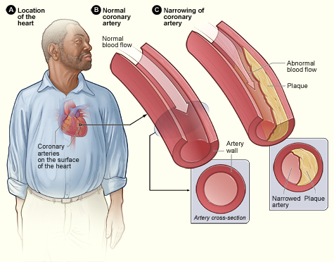 HIV infected men at increased risk for heart disease 