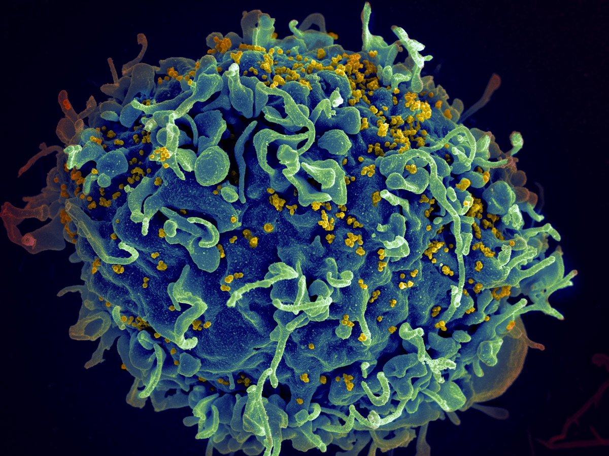 HIV, the AIDS virus (yellow), infecting a human immune cell