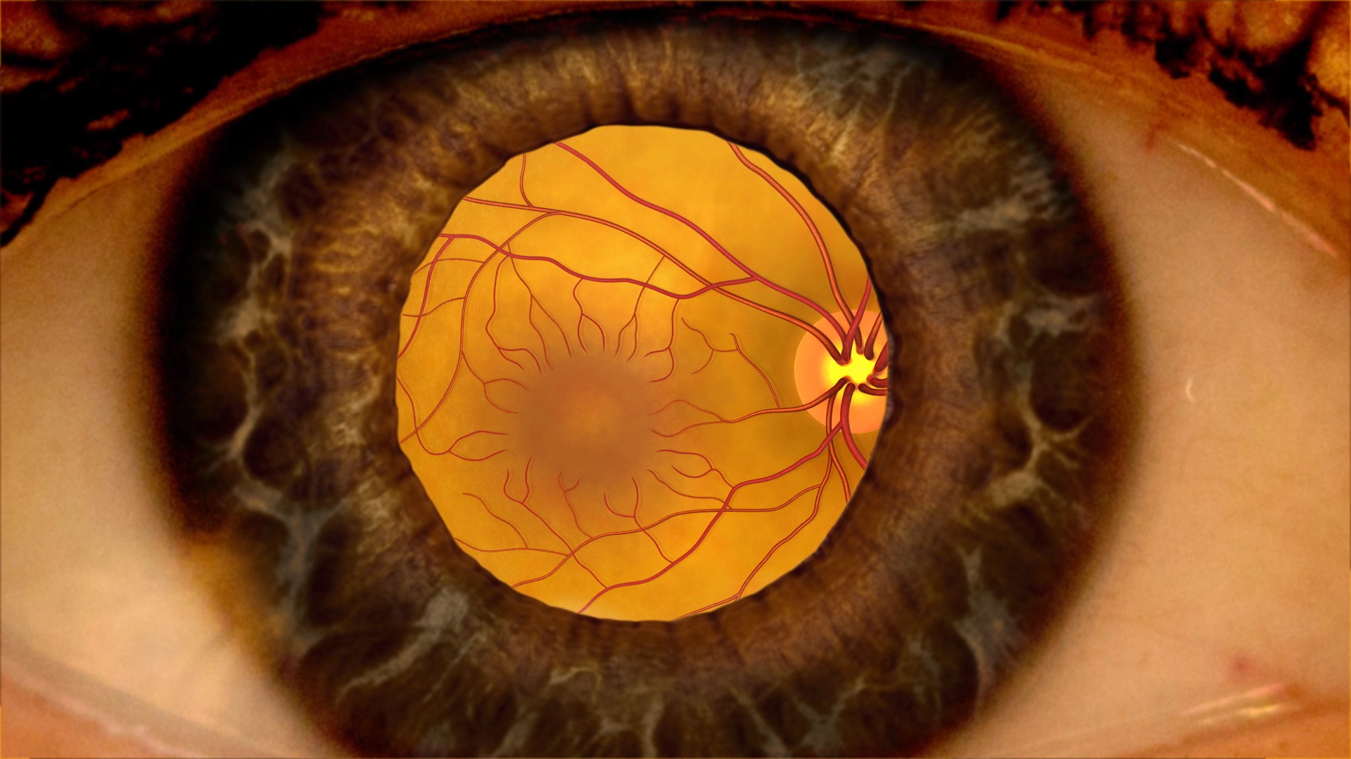 diabetic macular edema