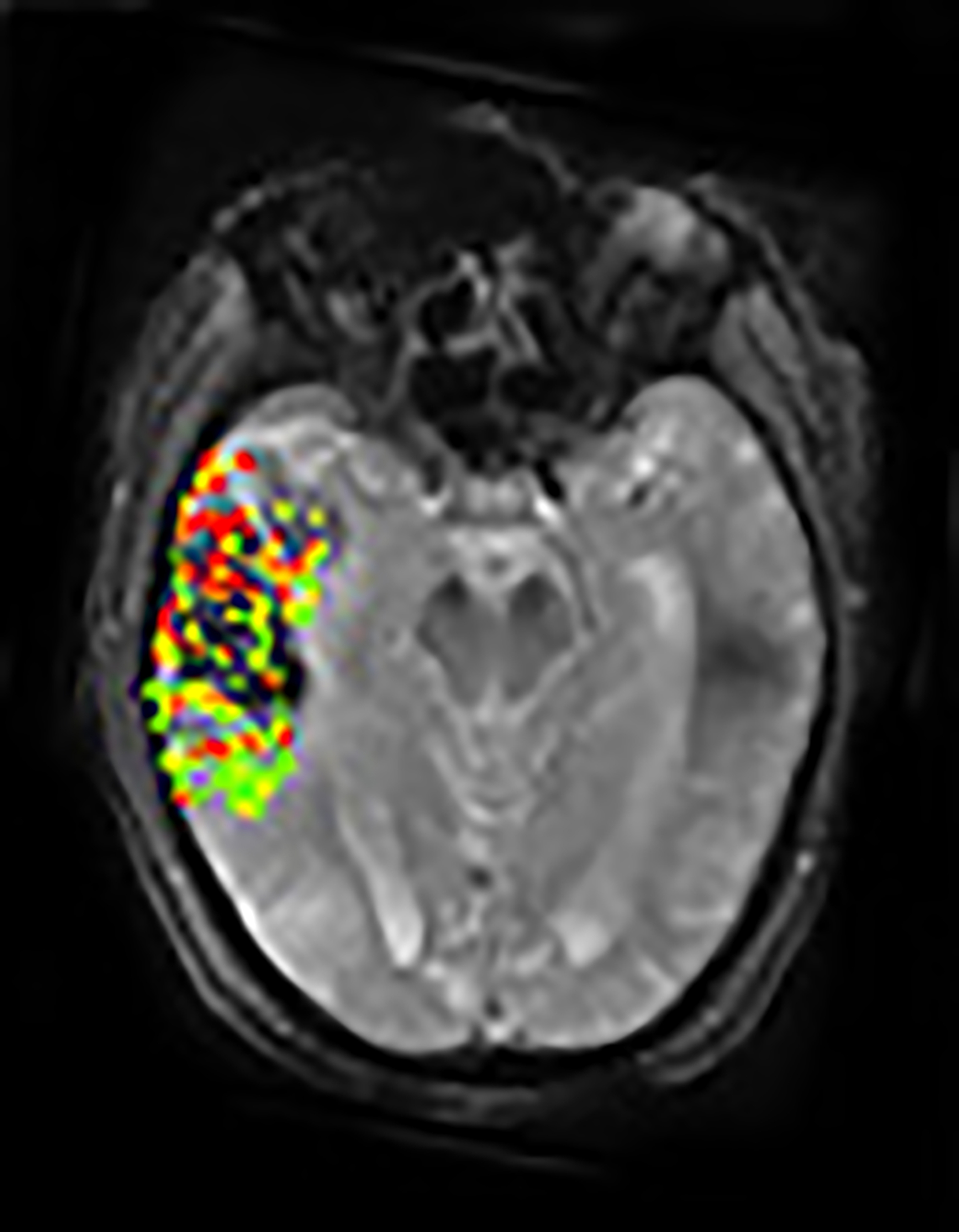 Image of stroke brain