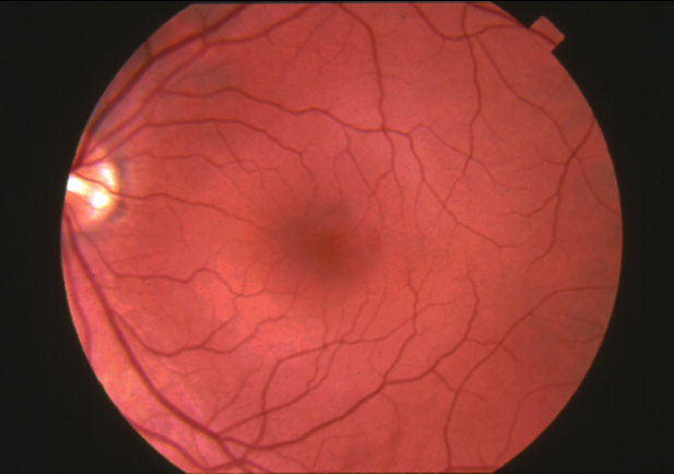 Normal Retina  Fundus photograph-normal retina.