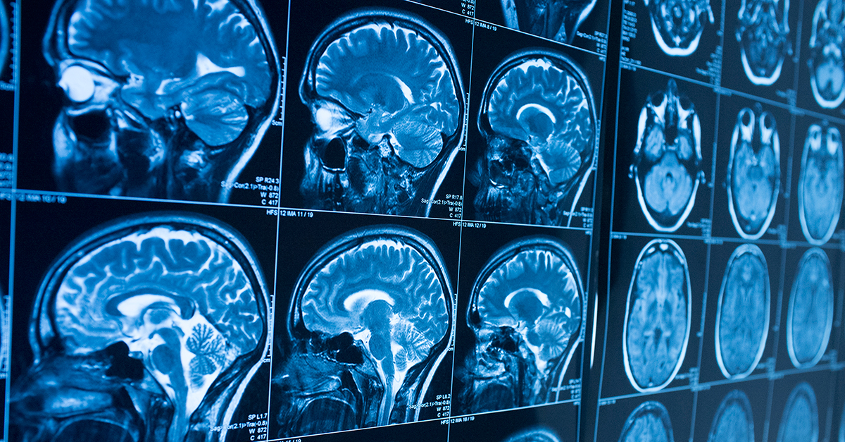 Head x-ray, brain in MRI