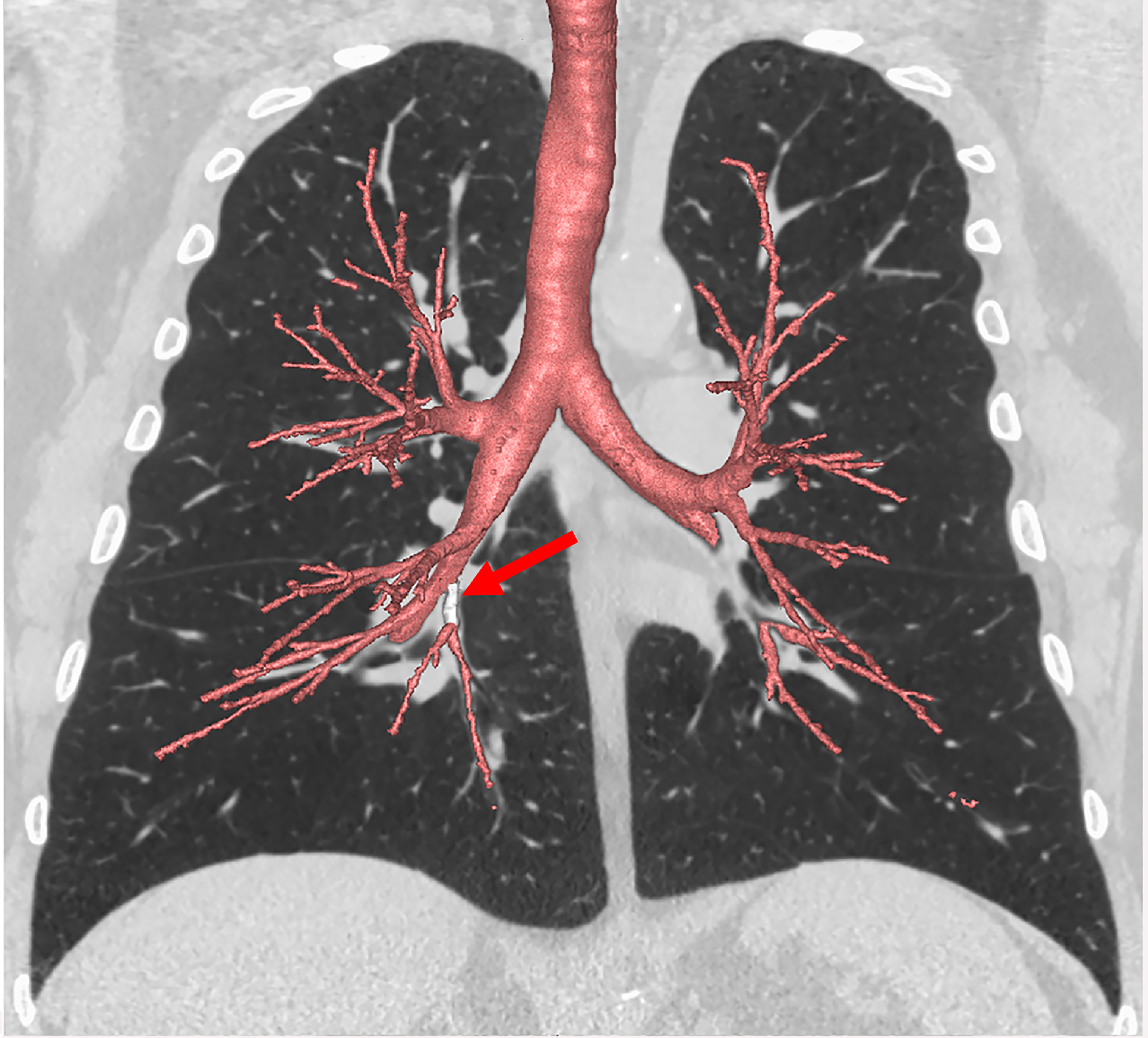 Images of the lungs highlighting the airway branches
