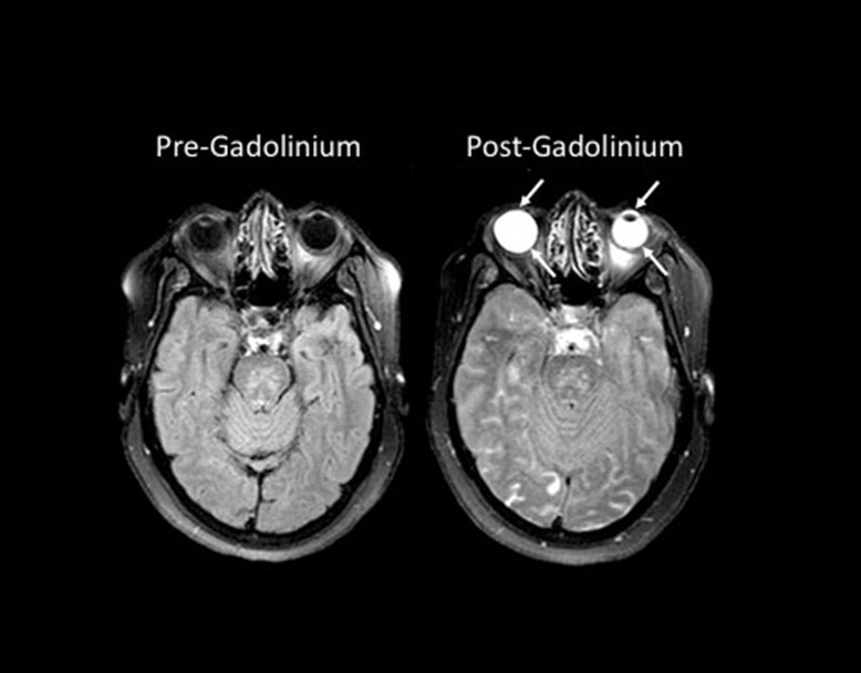 MRI scans of a stroke patient’s brain
