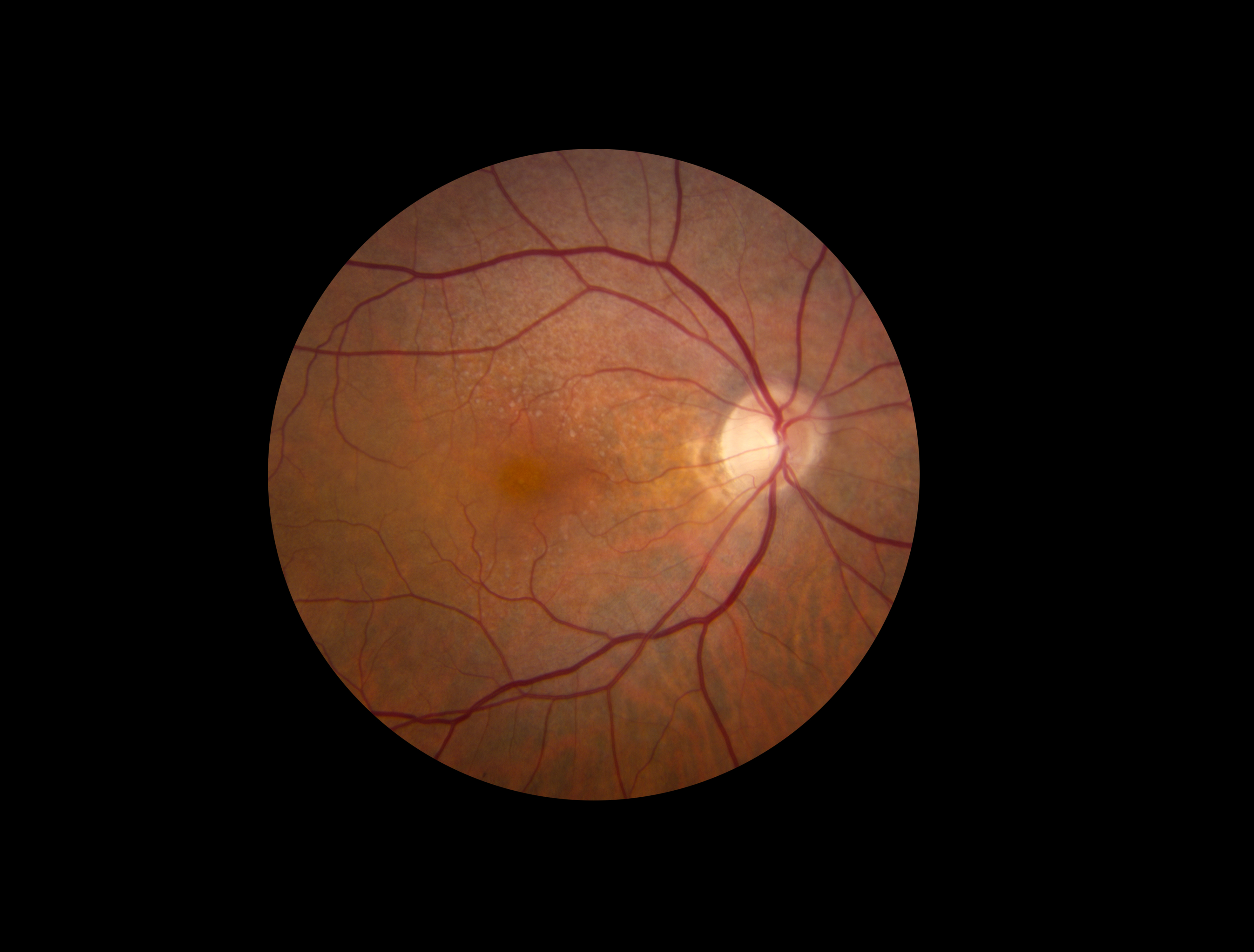 Image of retina with reticular pseudodrusen