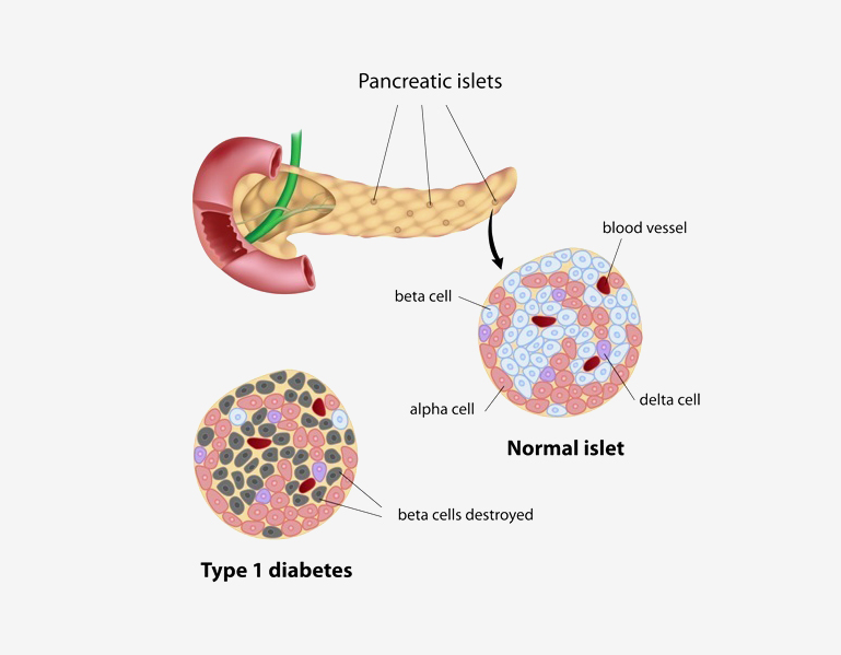 An illustration of  pancreatic islets in type one diabetes  