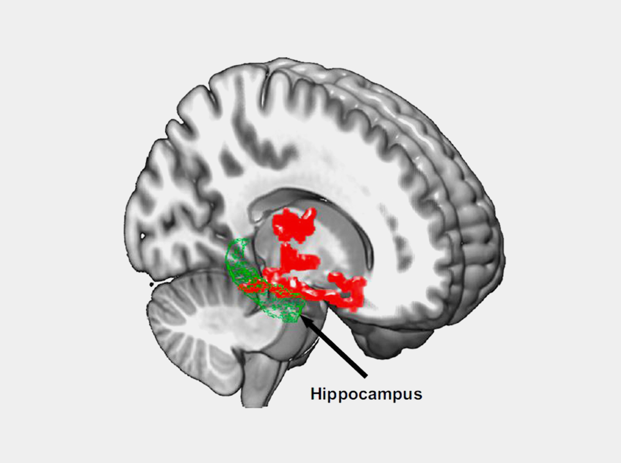 Illustration of beta-amyloid accumulation