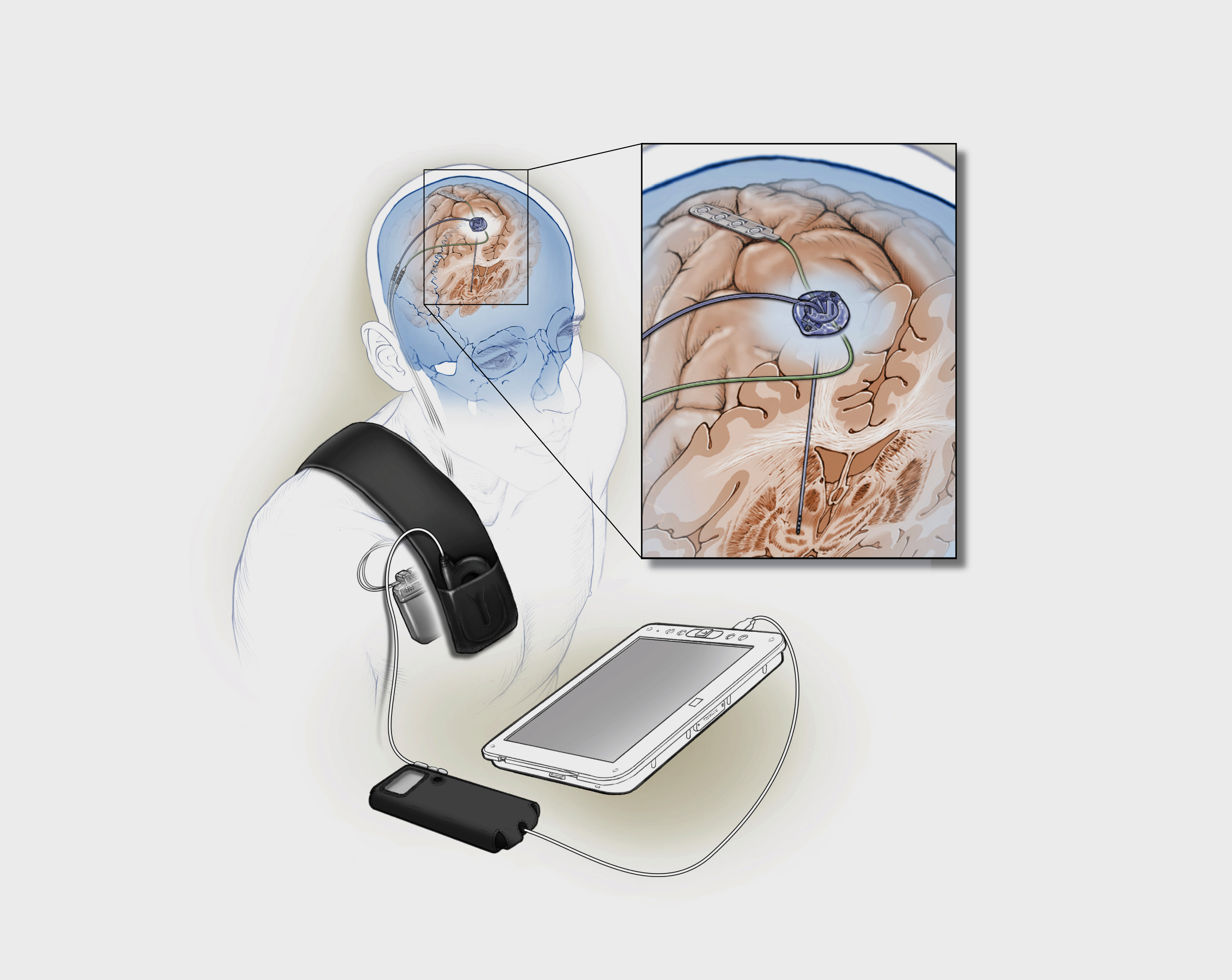 Image of Implanted deep brain stimulation device 