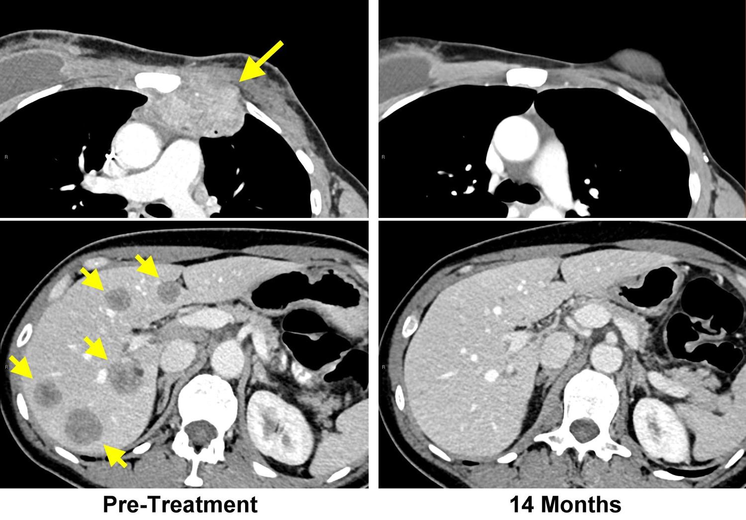 CT scans from cancer patient