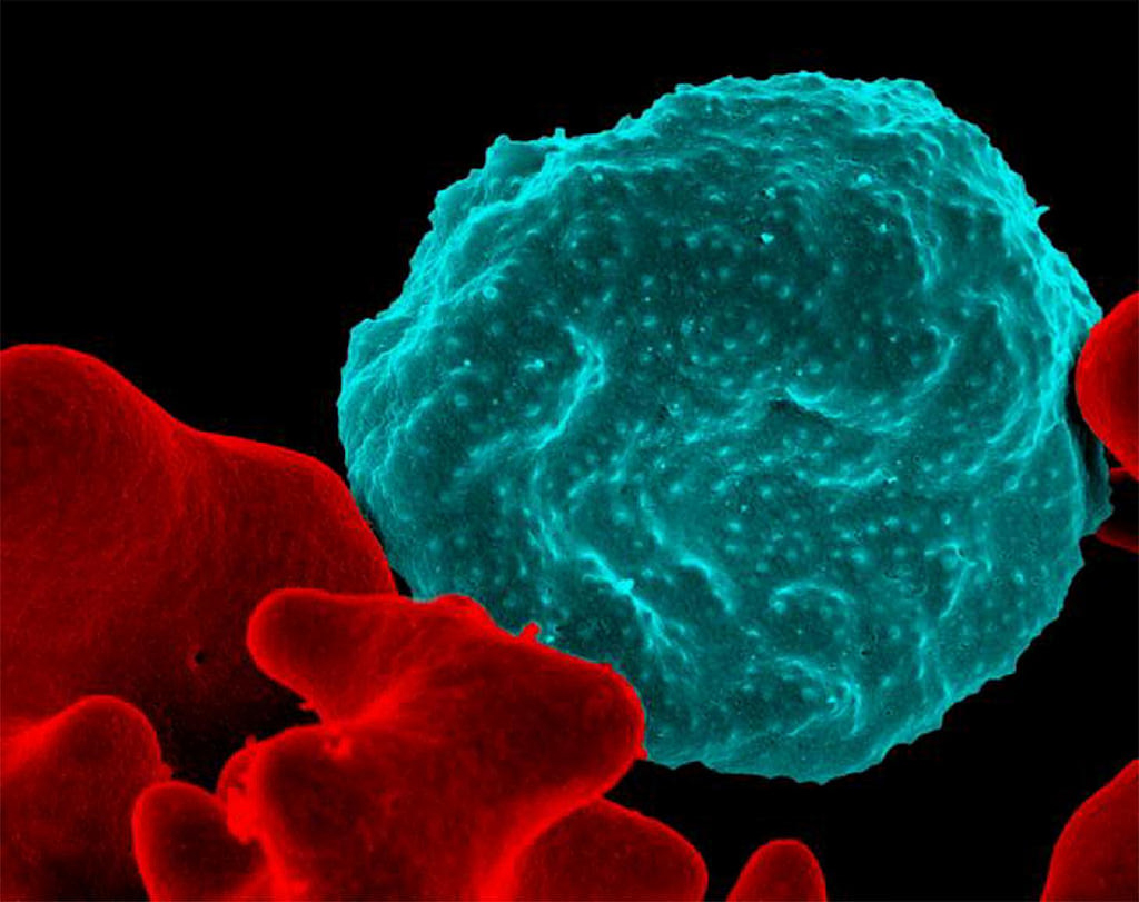 Malaria-infected Red Blood Cell