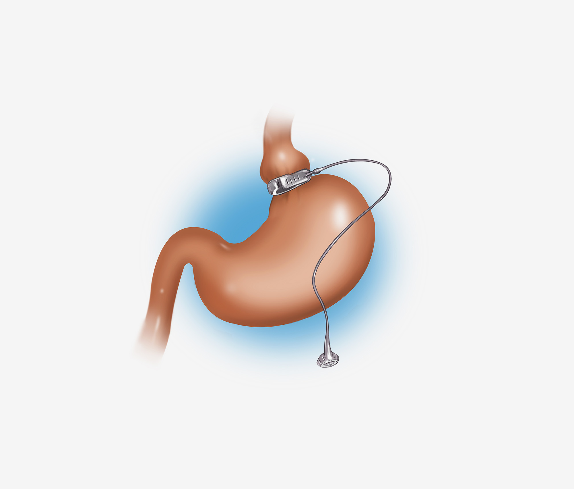 Illustration of a gastric band