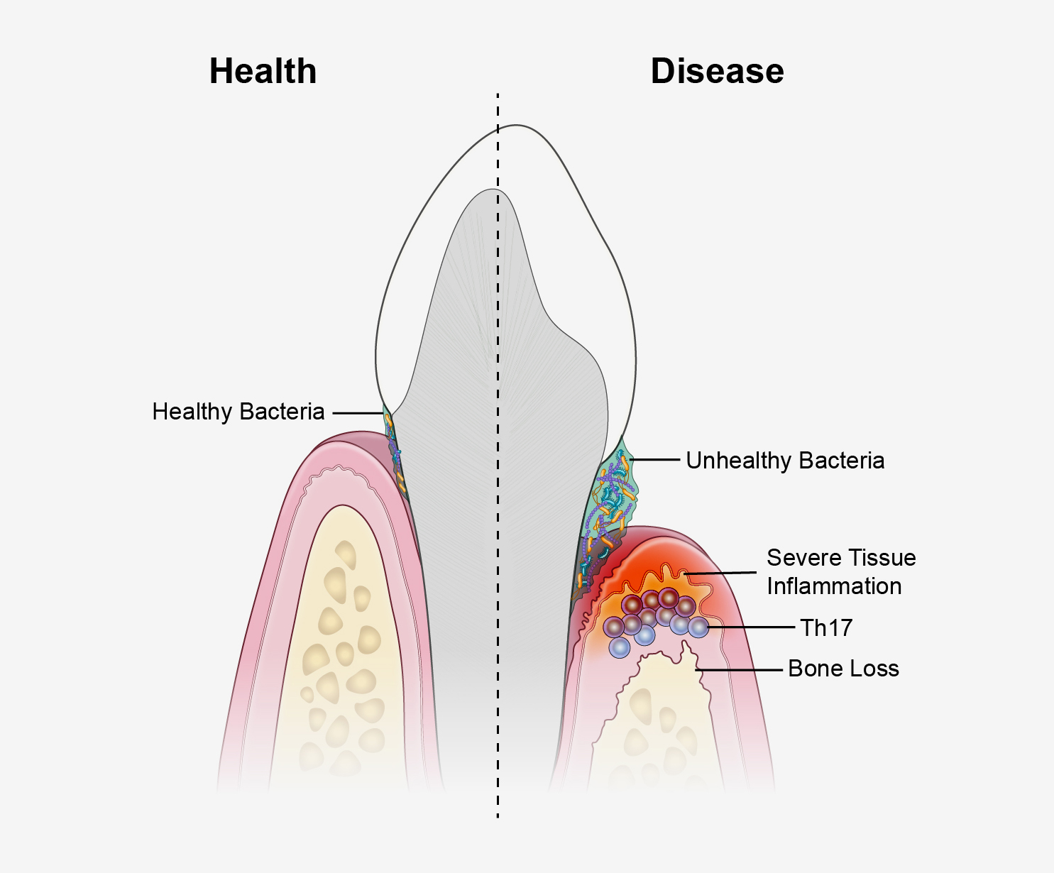 Illustration of tooth, gum, and bacteria.