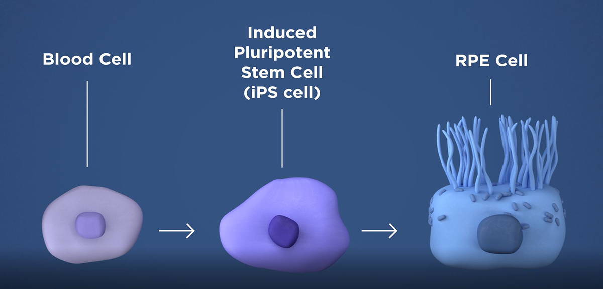 Image of a blood cell turning into an induced pluripotent stem cell and then an RPE cell