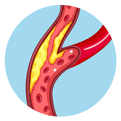 Illustration of plaque in an artery.