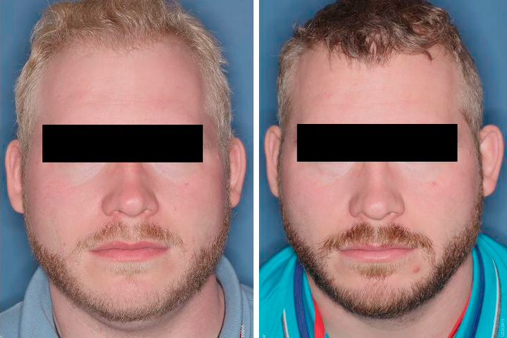 Photos of study participant with pale hair, left, and darker hair, right.