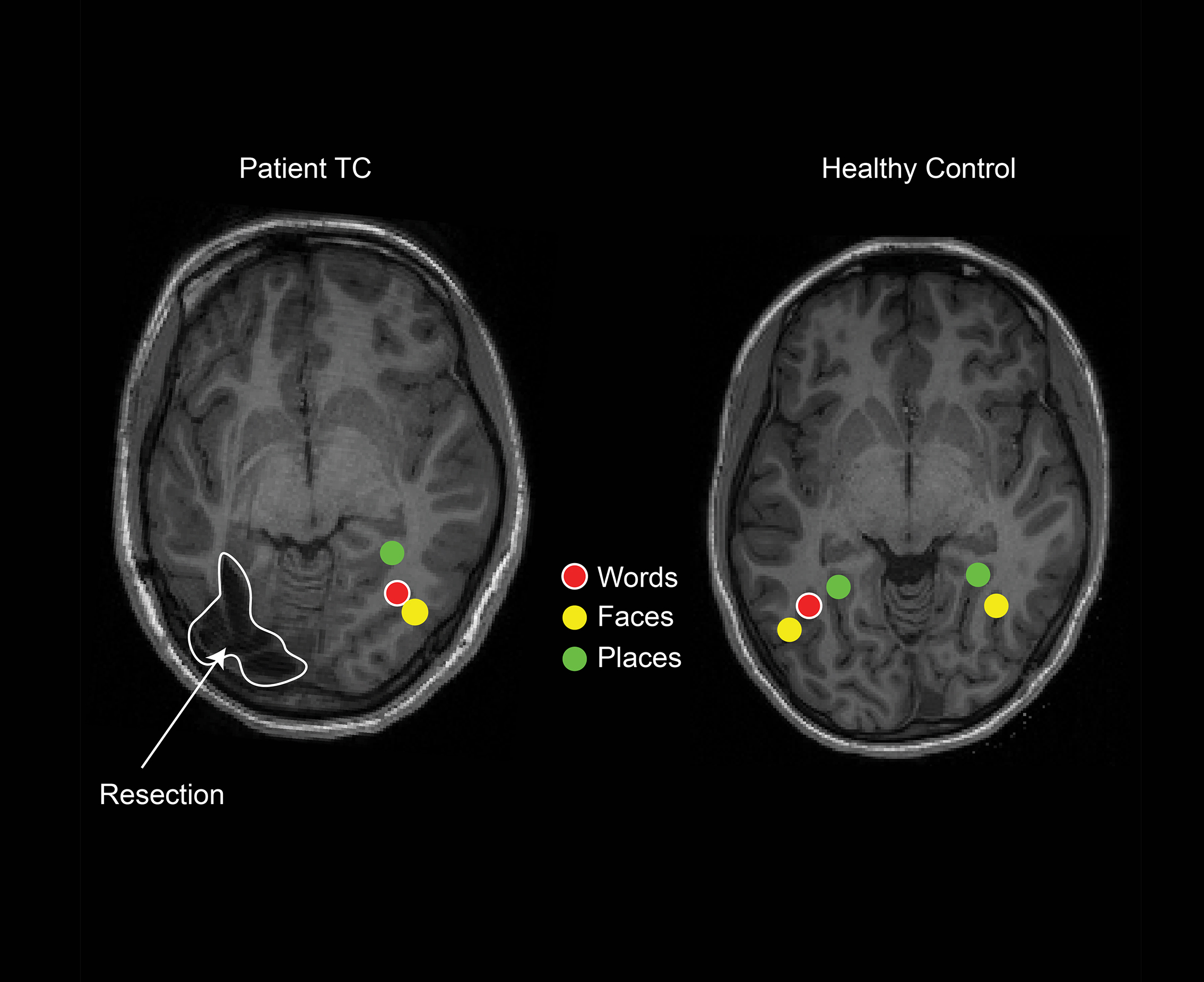 2D MRI brain scans of patient TC and a healthy control child reveal word, place, and face specific regions. Patient TC shows all three on the right, and resected region on the left. Healthy control has all three on the left, plus face and place on the rig