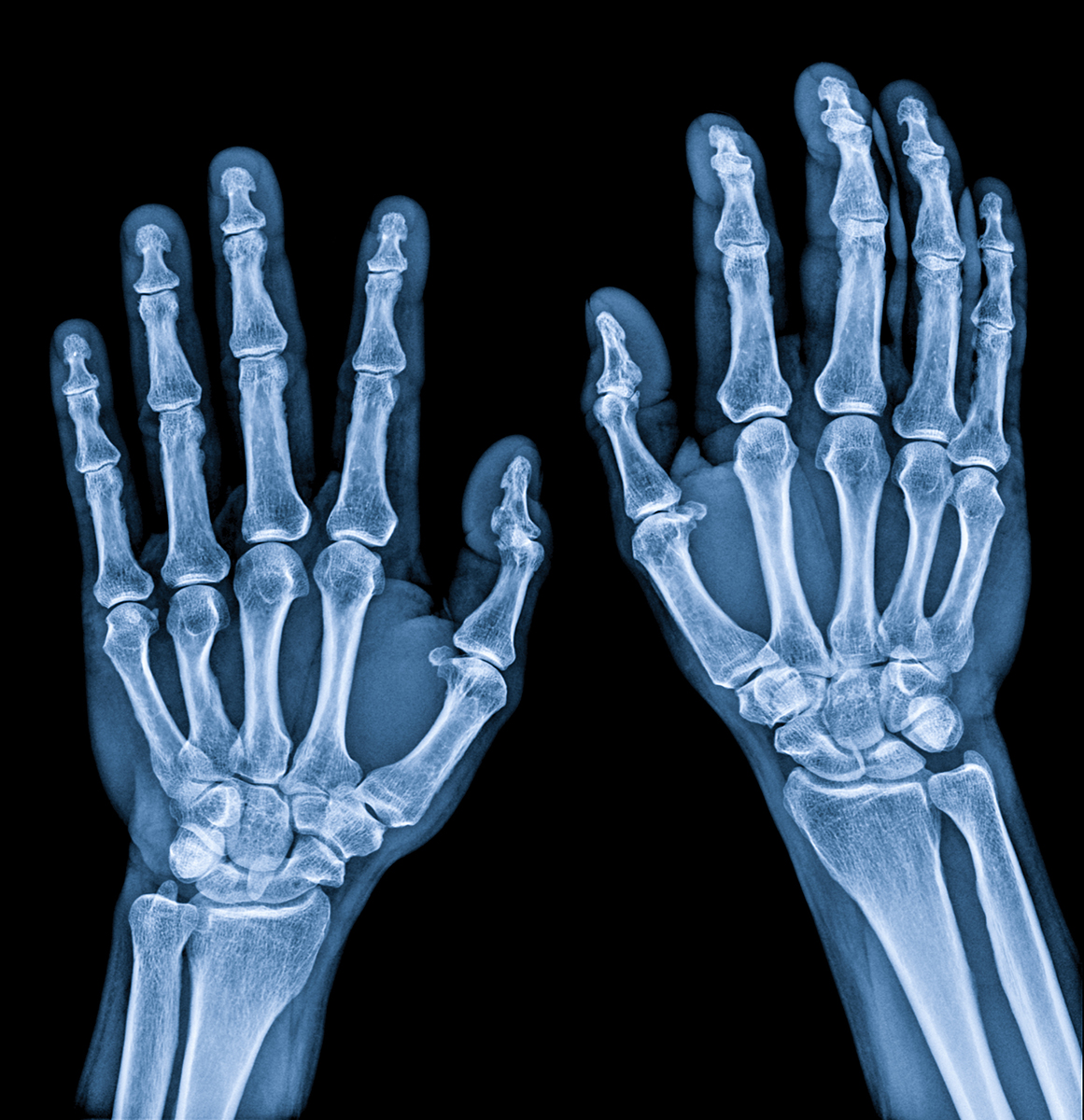 X-ray image of two hands